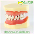 Modèle dentaire de la maladie parodontale EN-L4 avec la gencive molle démontable